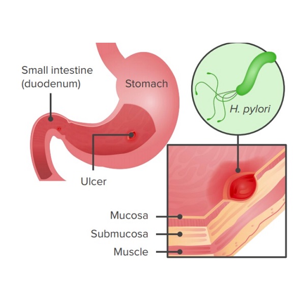 Helicobacter Pylori, Infection, Virulence Factors and Treatment A Review